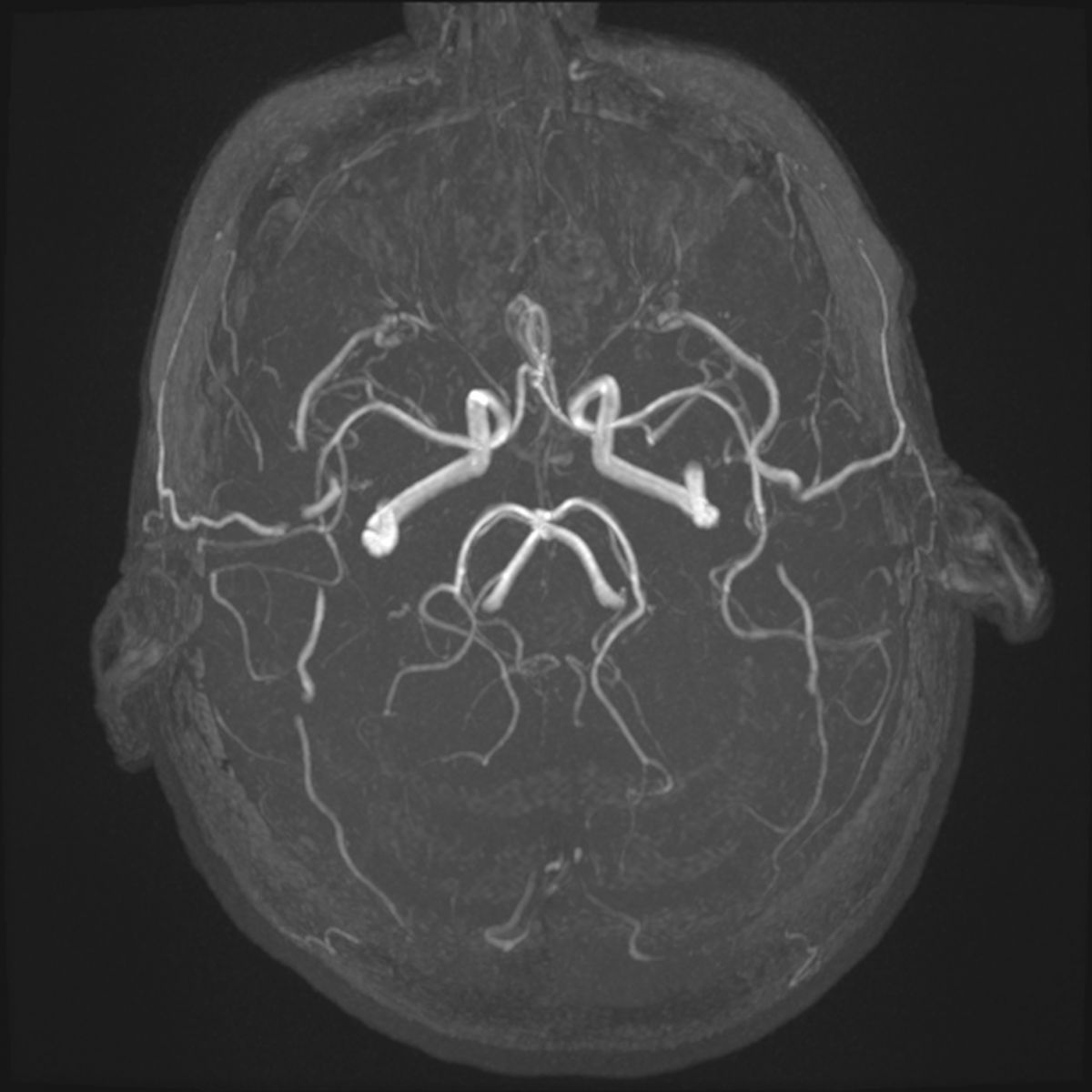 Angio risonanza magnetica del distretto vascolare intracranico (Angio RM cerebrale) presso Studio RX Gentile · Studio di radiologia a Bagheria