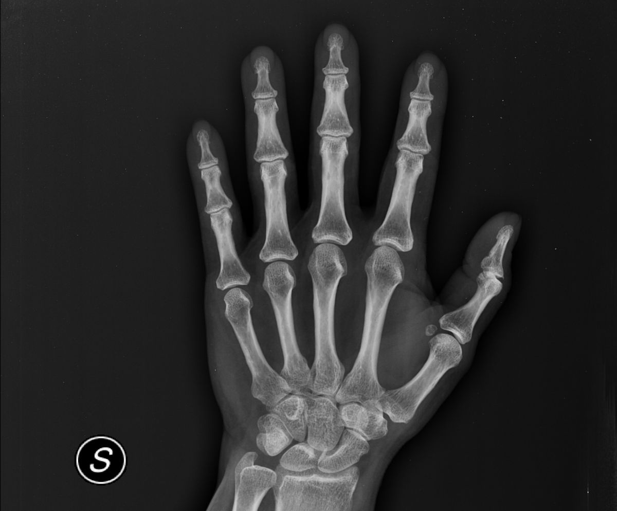 Radiografia della mano e delle dita (Rx mano e dita) presso Studio RX Gentile · Studio Radiologico a Bagheria, Palermo