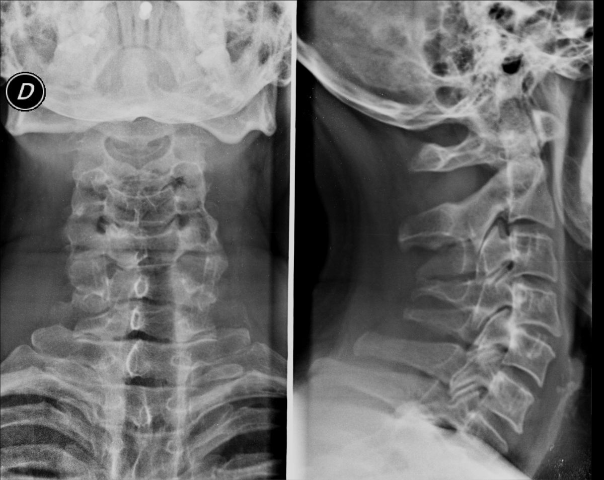 Radiografia della colonna vertebrale cervicale (Rx colonna cervicale) presso Studio RX Gentile · Studio Radiologico a Bagheria, Palermo