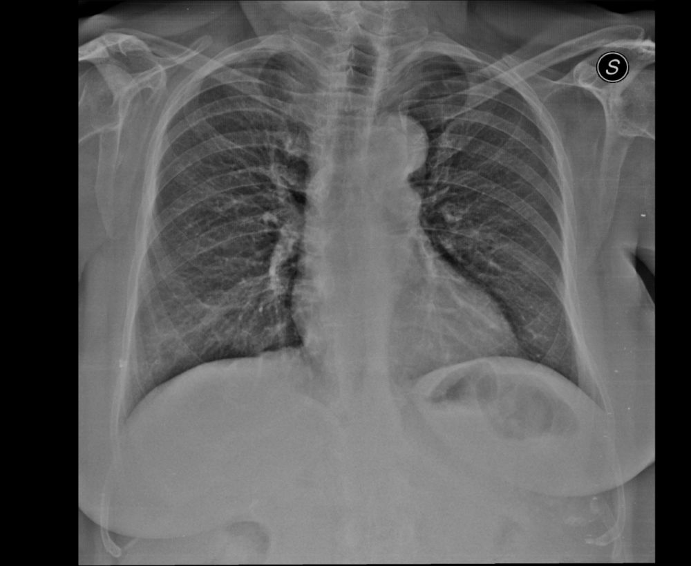 Radiografia del torace e Tac del torace ad alta risoluzione (HRCT)