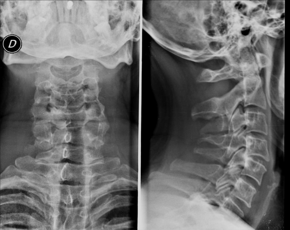 Radiografia della colonna vertebrale cervicale