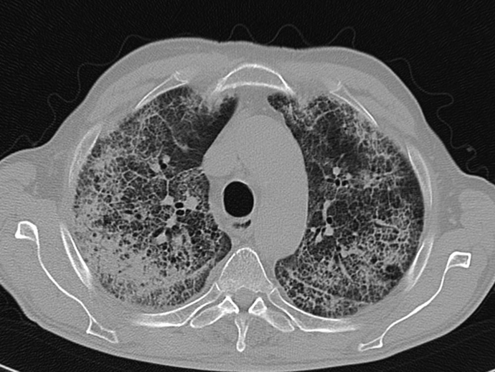 Indagini radiologiche nel Covid 19 - Rx del Torace e Tc del torace ad alta risoluzione