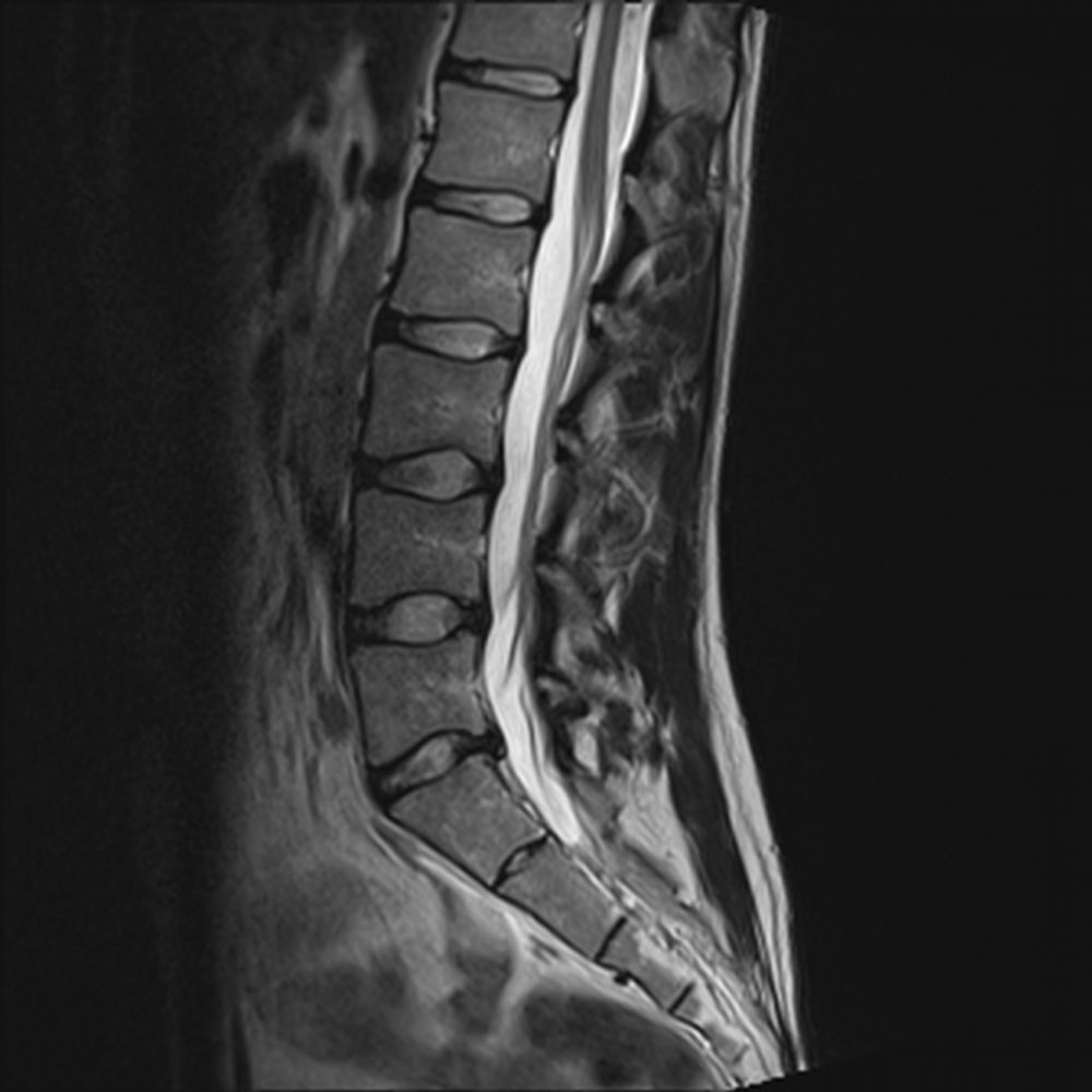 Dolore da Fissurazione del Disco Intervertebrale: Quando è Utile una Risonanza Magnetica della colonna lombare