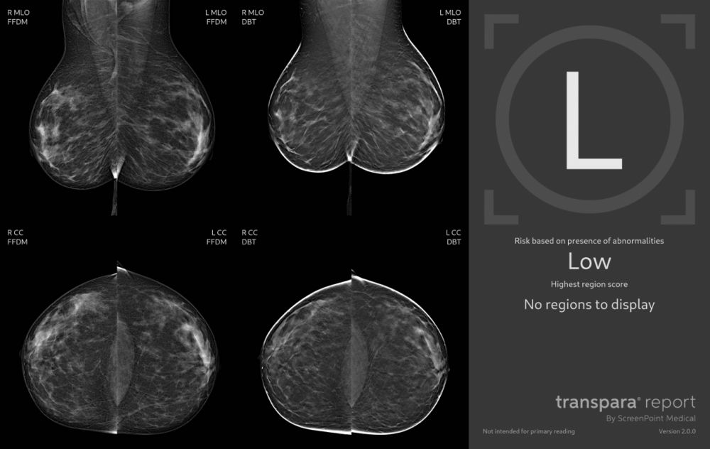 Intelligenza Artificiale in Mammografia a Bagheria: incremento del 29% del tasso di rilevazione di tumore al seno